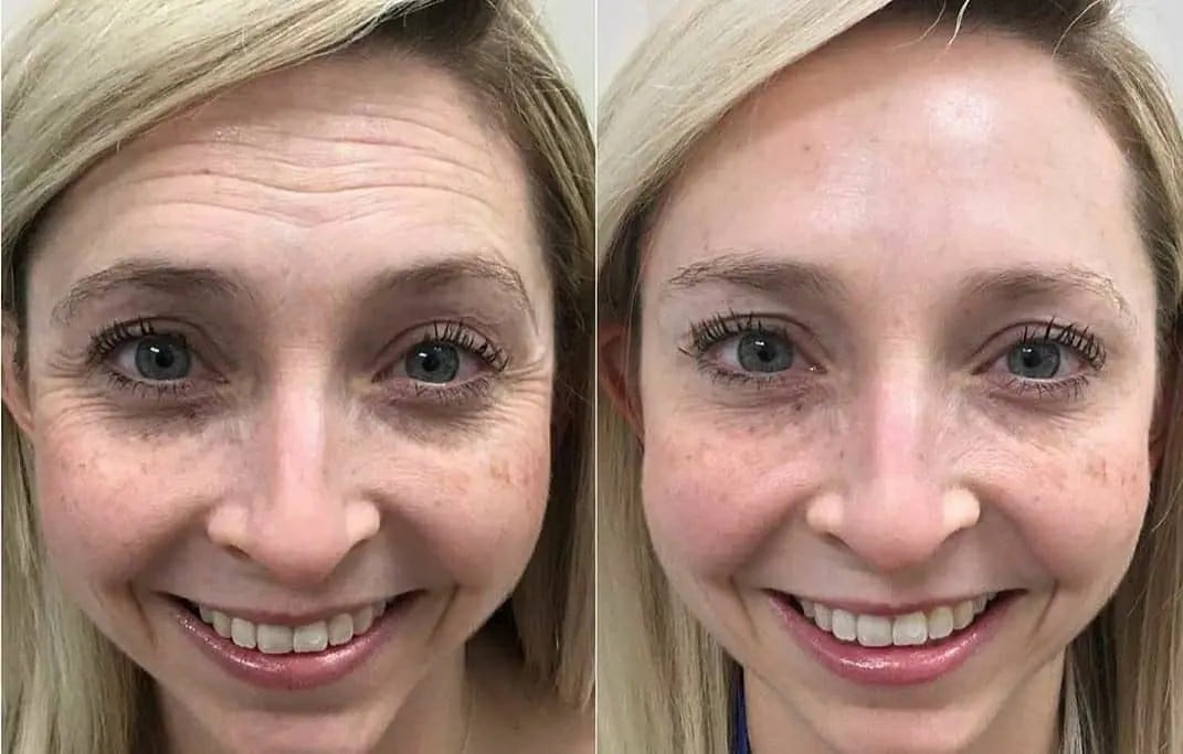 Harmonização Facial