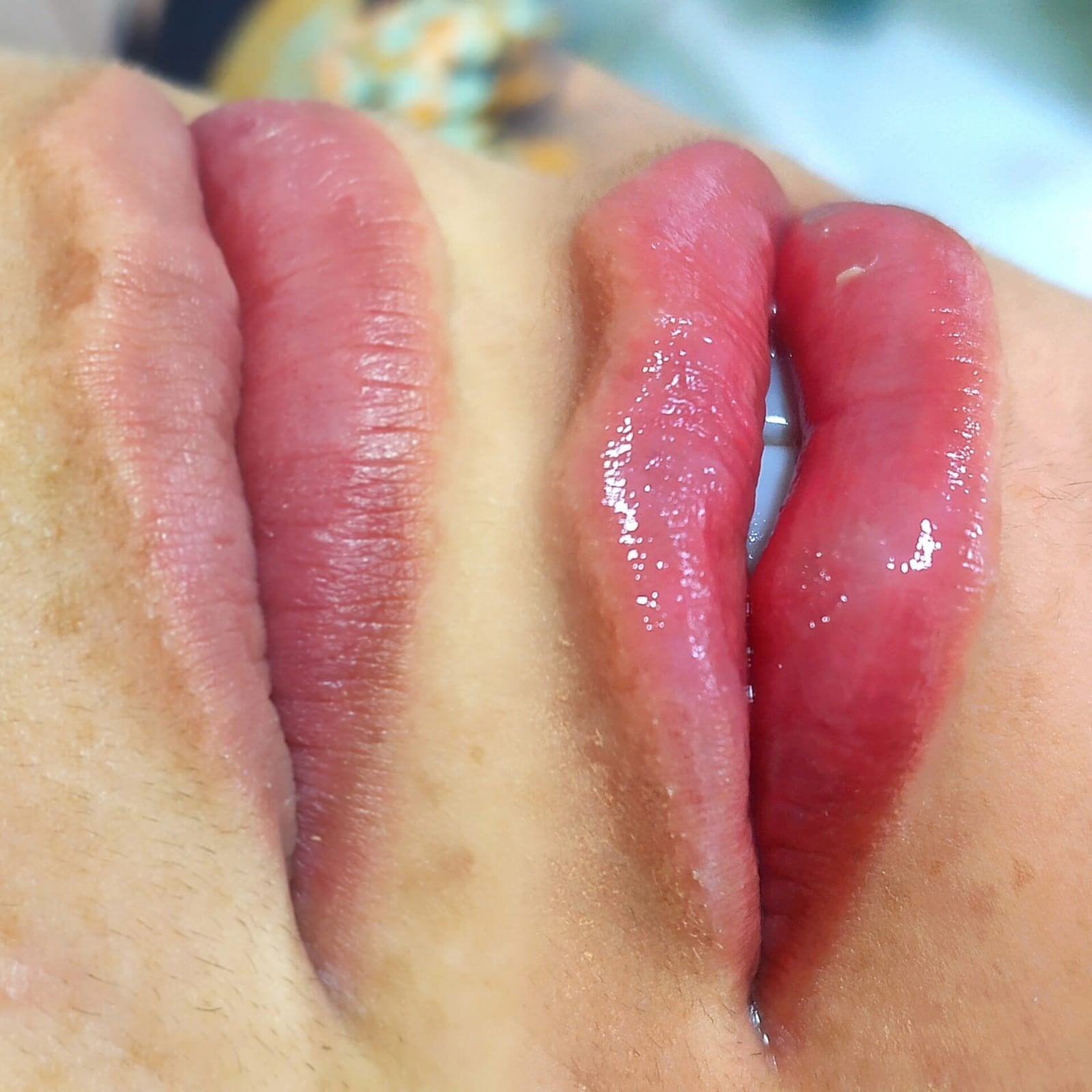 Preenchimento Labial